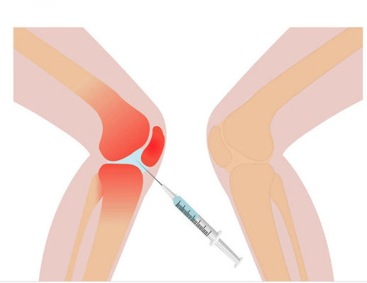 Soluzione mesoterapica per dolore al ginocchio da 3 ml Acido ialuronico non reticolato