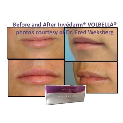 Acido ialuronico gel di riempimento del viso Juvederm pelle liscia e impeccabile