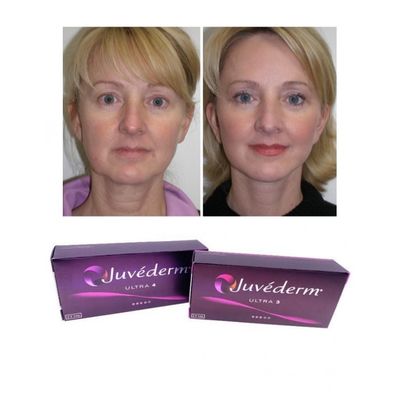 6-9 mesi Durazione Gel di riempimento cutaneo Juvederm Acquisto online e in negozio
