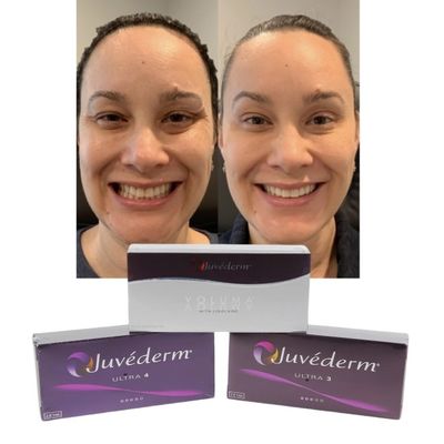 Juvederm Dermal Lip Fillers Acido ialuronico Iniezione incrociata