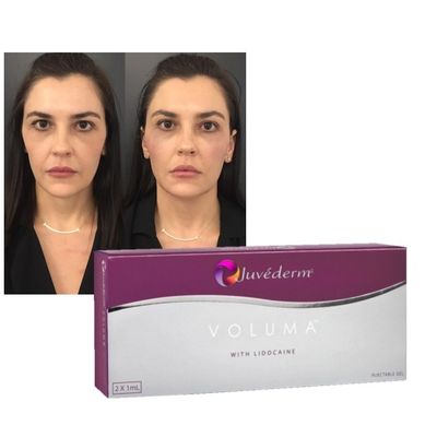 Juvederm Dermal Lip Fillers Acido ialuronico Iniezione incrociata