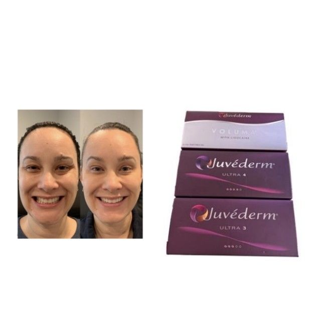 Filler dermico Juvederm con HA reticolato Ultra3 Ultra4 Voluma Condizioni di conservazione Evitare il congelamento Gel iniettabile per il ripristino del volume del viso