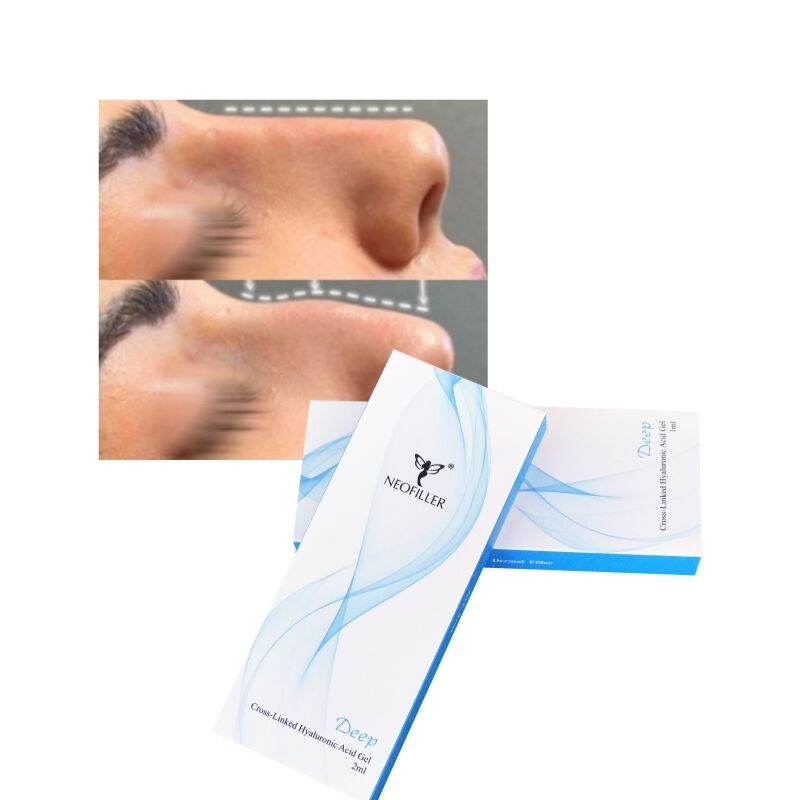 Filler dermico con acido ialuronico reticolato da 2 ml Linea profonda Contorno del naso Gel iniettabile Miglioramento del viso