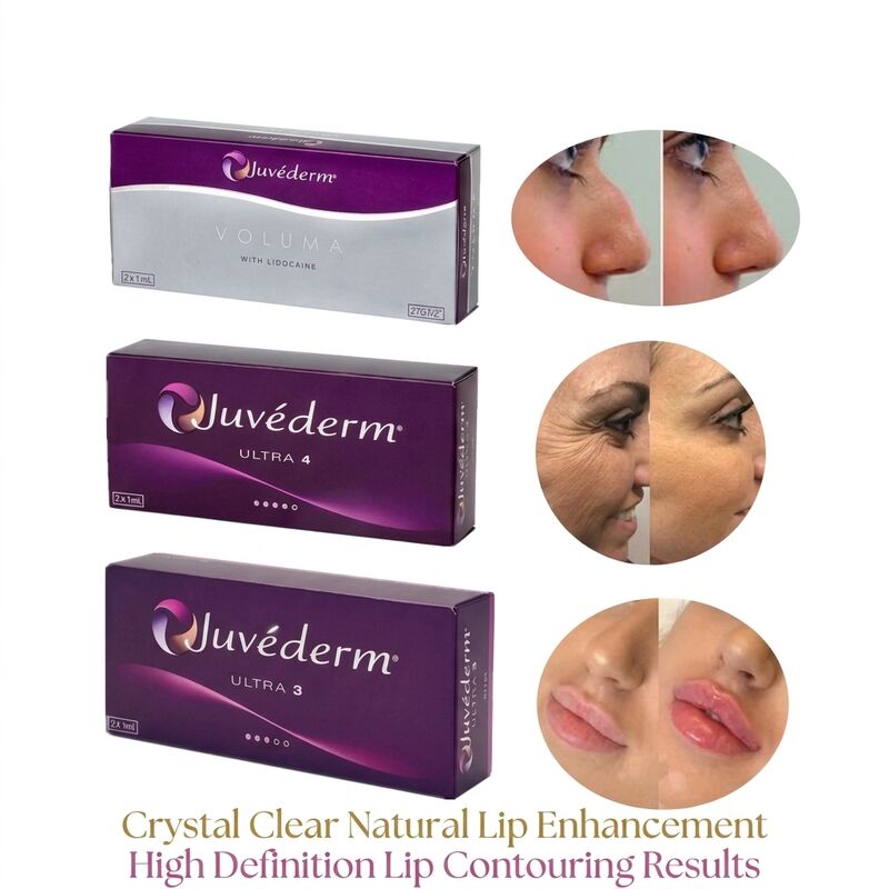 Volume della siringa 2 1 ml per scatola Juvederm Voluma Filler Safety Facial Contouring Injectable Dermal Filler per aumento del volume